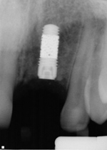 Zimmer trabecular metal implant